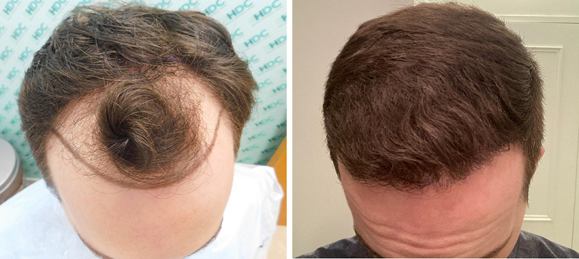 3300 grafts on NW 3 patient – 7 Months after 